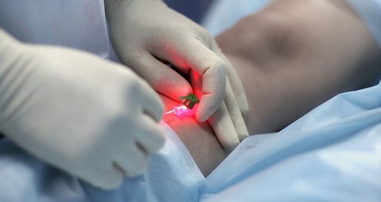 Chirurgische Behandlung von Krampfadern.