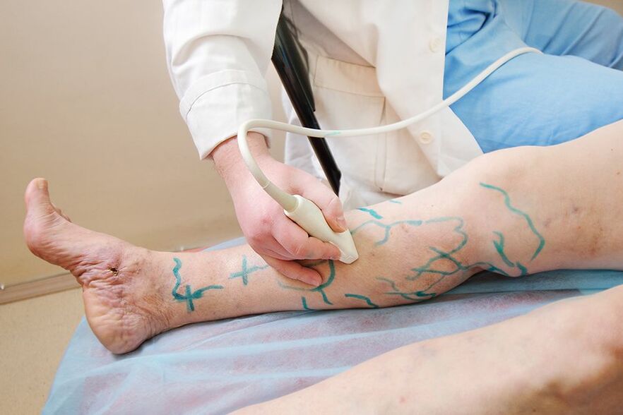 Vorbereitung zur Miniphlebektomie, Markierung der Beinperforatoren und Durchführung einer Ultraschalluntersuchung